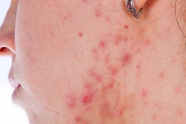 Skincare Basics: What is Acne and How to Treat It