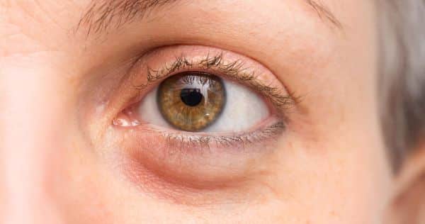 Eye Bags