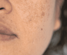Melasma & Hyperpigmentation