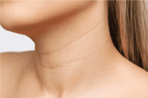 Neck Wrinkles & Sagging