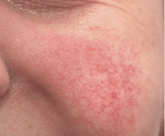 Rosacea