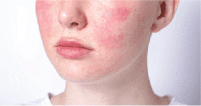 Sensitive Skin