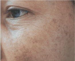 Sun Damage