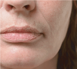 Collagen Degradation