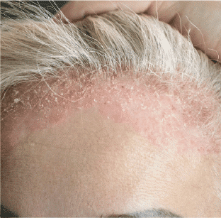 Eczema
