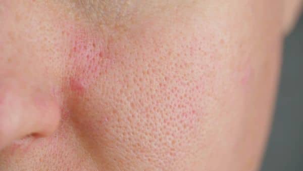 Minimize Pores