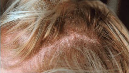 Oily, Flaky Scalp & Skin