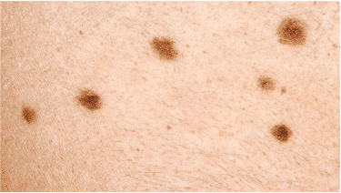 Skin Cancer