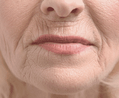 Collagen & Hyaluronic Acid Loss