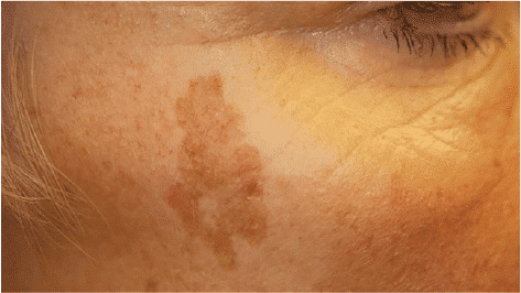 Pigmentation & Sun Spots