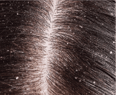 Dandruff