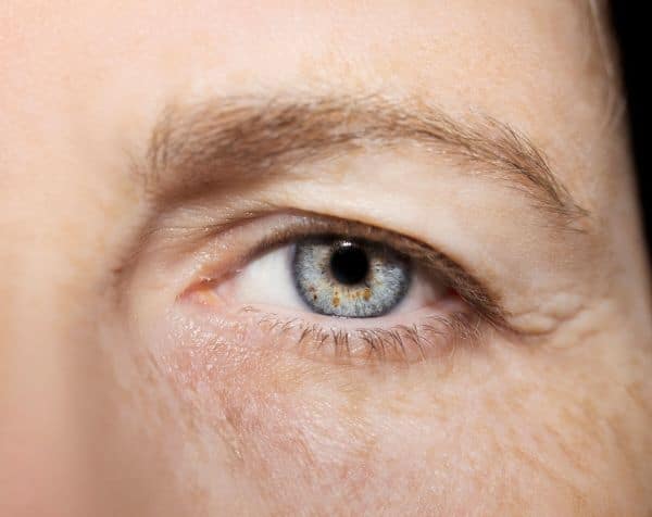Droopy Eyelid