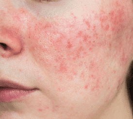 Sensitive Skin