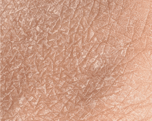Skin Barrier Support