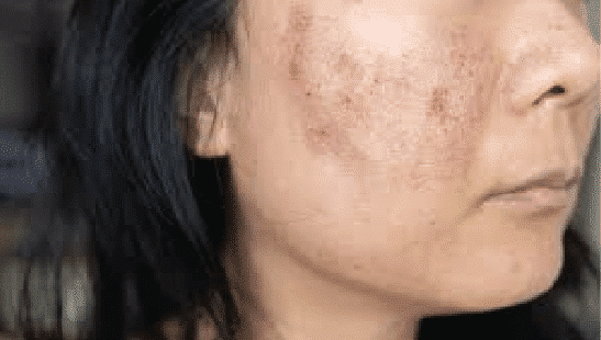 Uneven Skin Tone