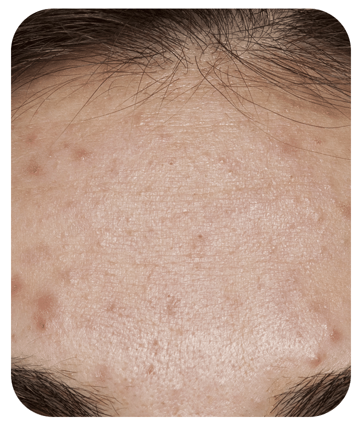 Designed to address Acne
