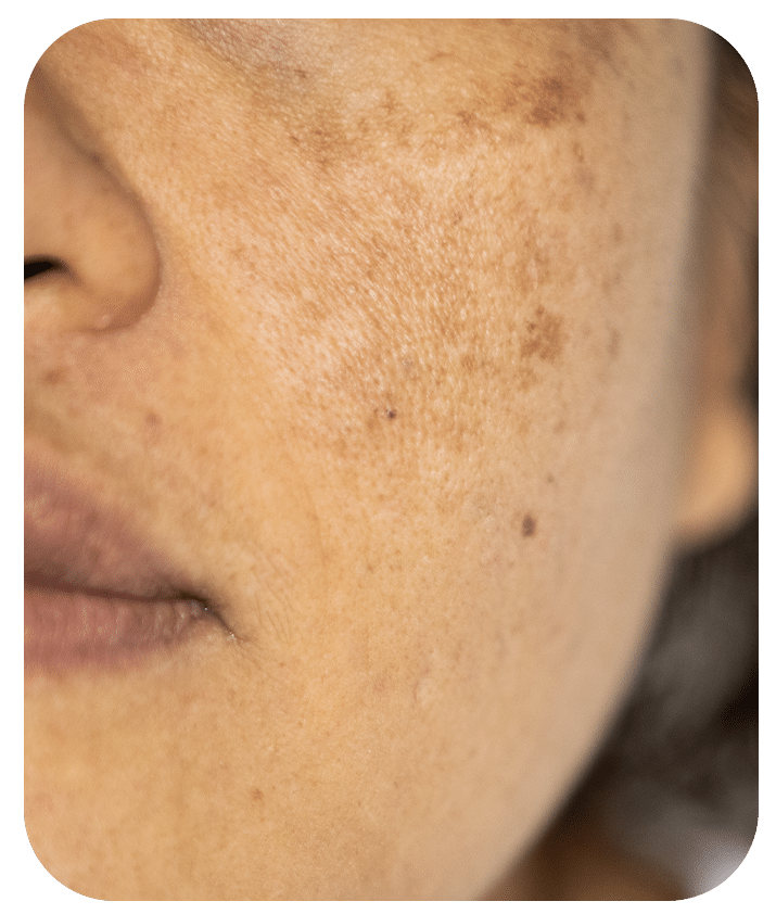 Designed to address Pigmentation