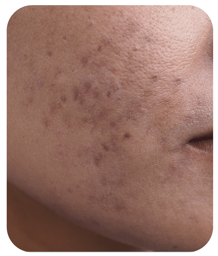 Designed to address Acne Scars