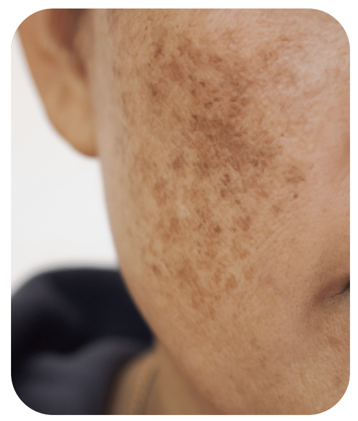 Designed to address Dark Spots