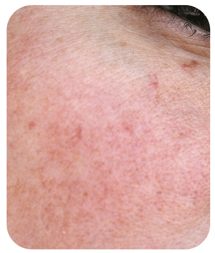 Designed to address Redness