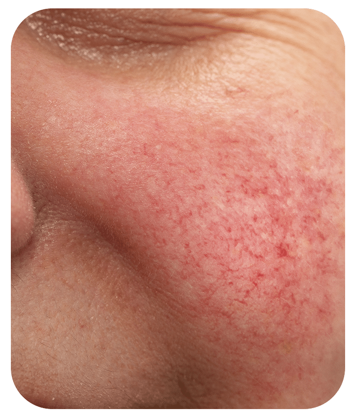 Designed to address Rosacea