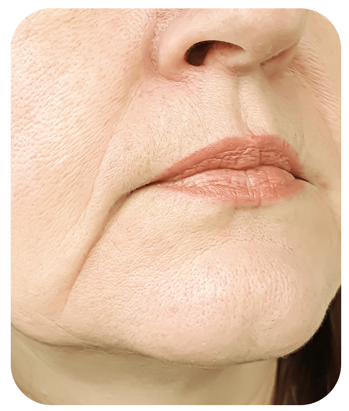 Designed to address Skin Sagging