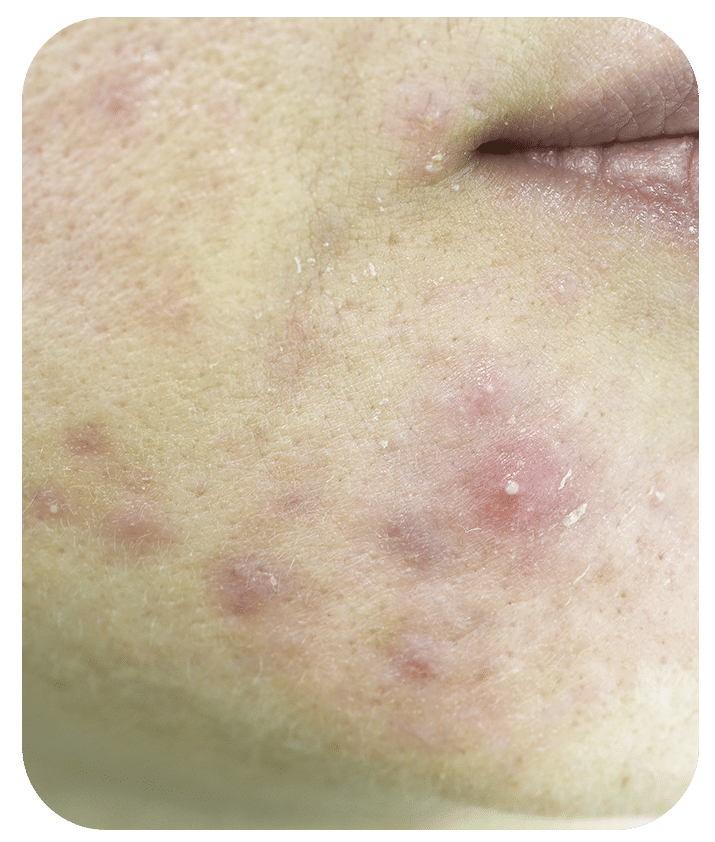 Designed to address Whiteheads