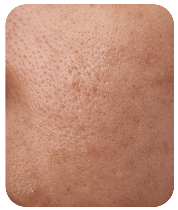 Designed to address Clogged Pores