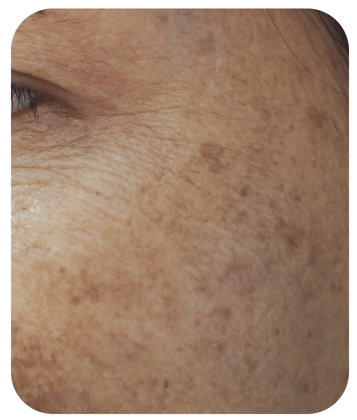 Designed to address Sun Damage