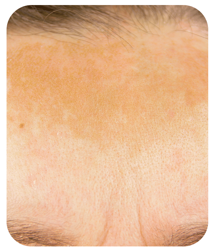 Designed to address Melasma
