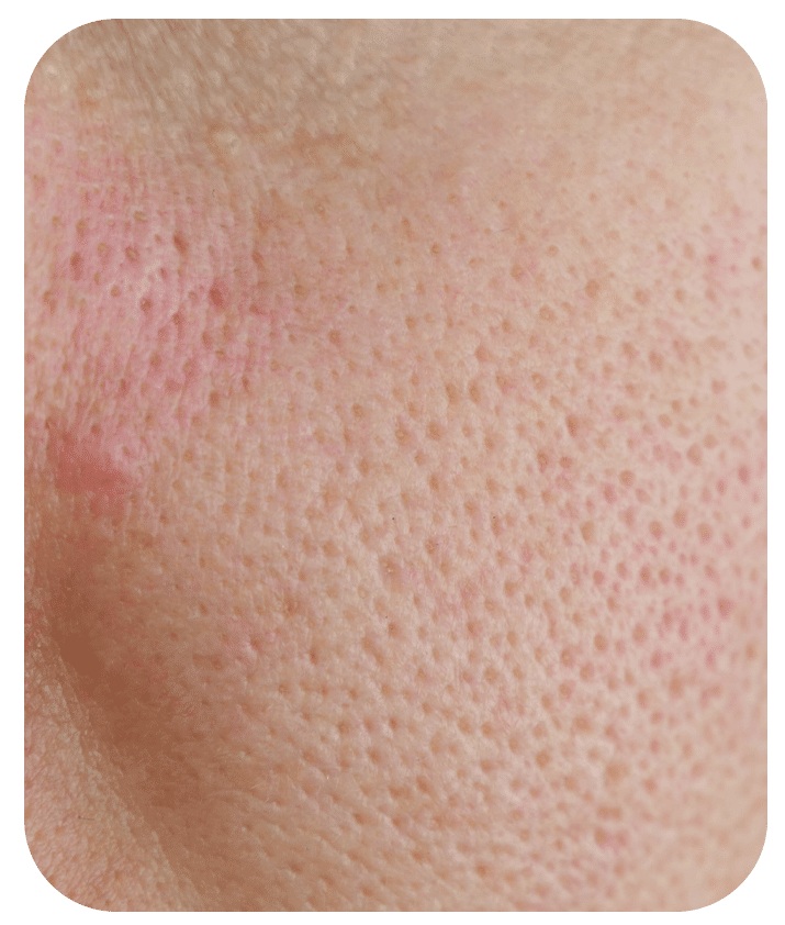 Designed to address Enlarged pores