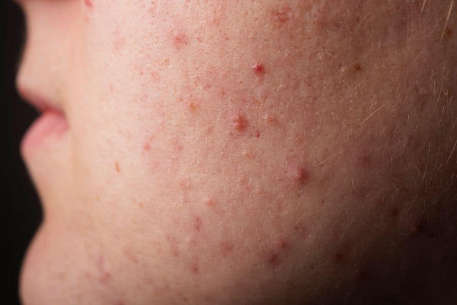 Papules & Pustules
