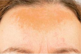 Uneven Tone and Pigment