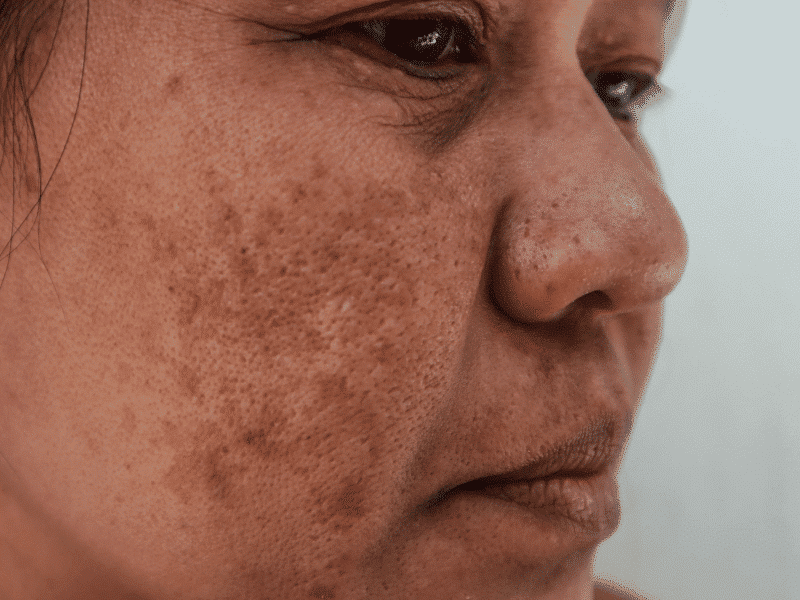 Inflammation & Injury (PIH)