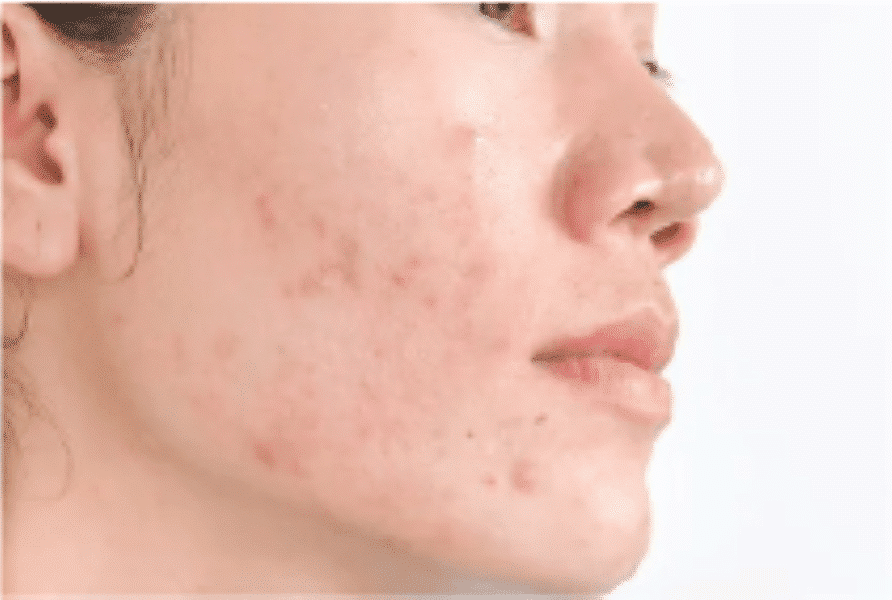 Post-Inflammatory Hyperpigmentation (PIH)