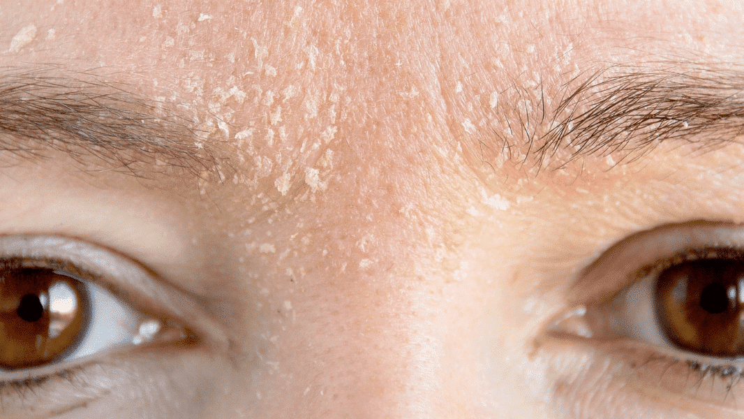 Compromised Skin Barrier