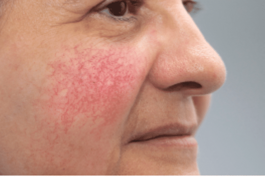 Erythematotelangiectatic (ETR)