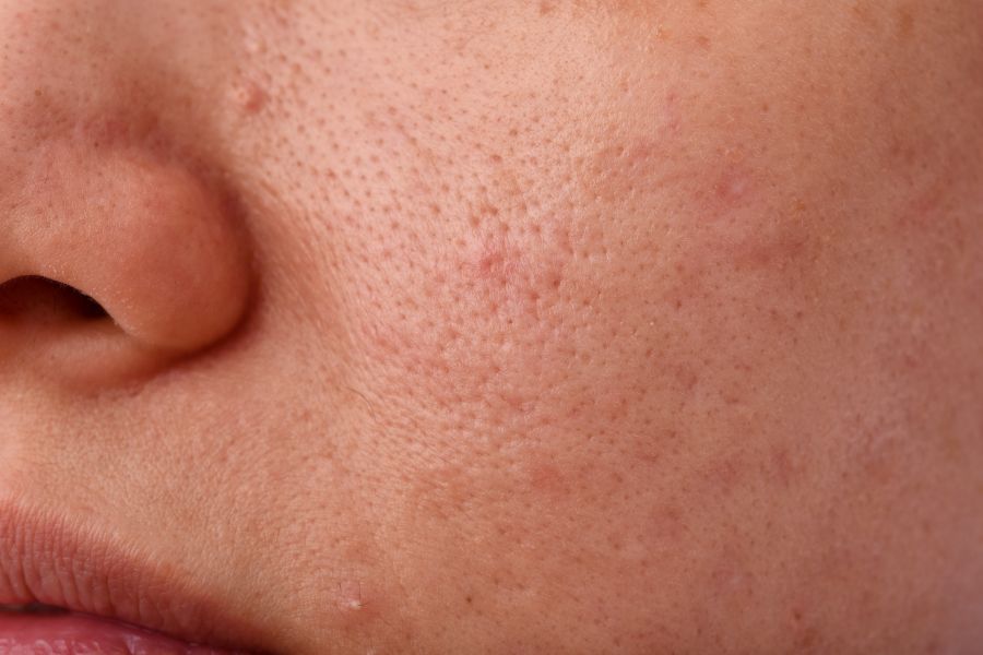 Clogged Pores