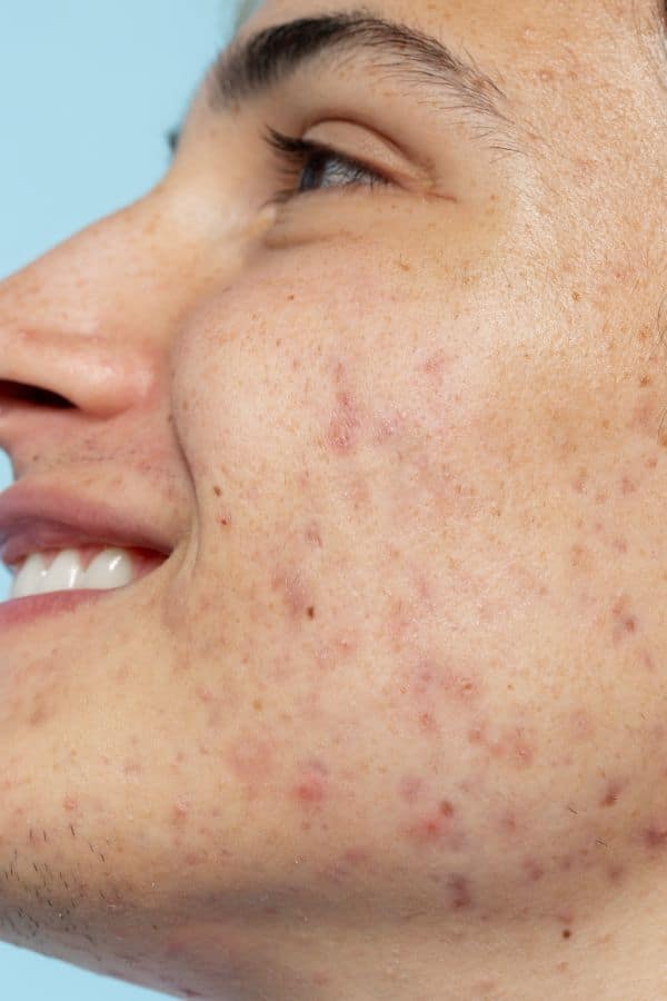 Cutibacterium acnes