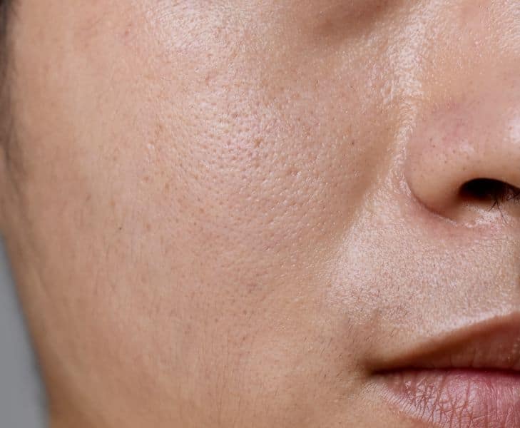 Excess Sebum