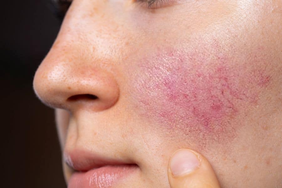 Inflammation