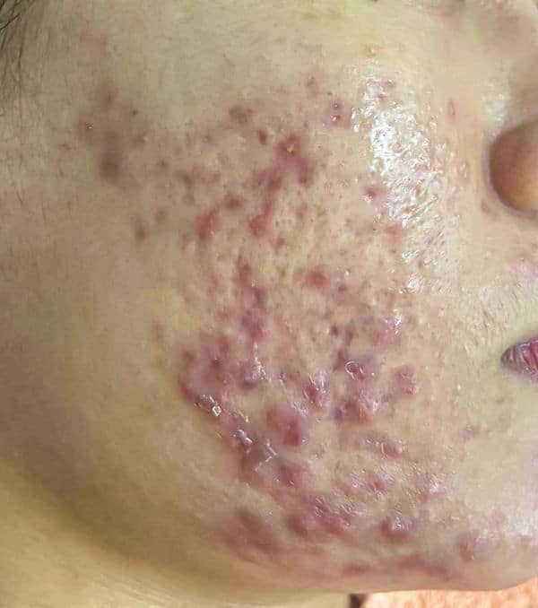 Nodules & Cysts