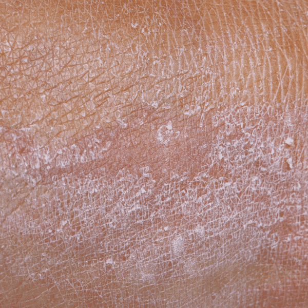 Keratin Buildup