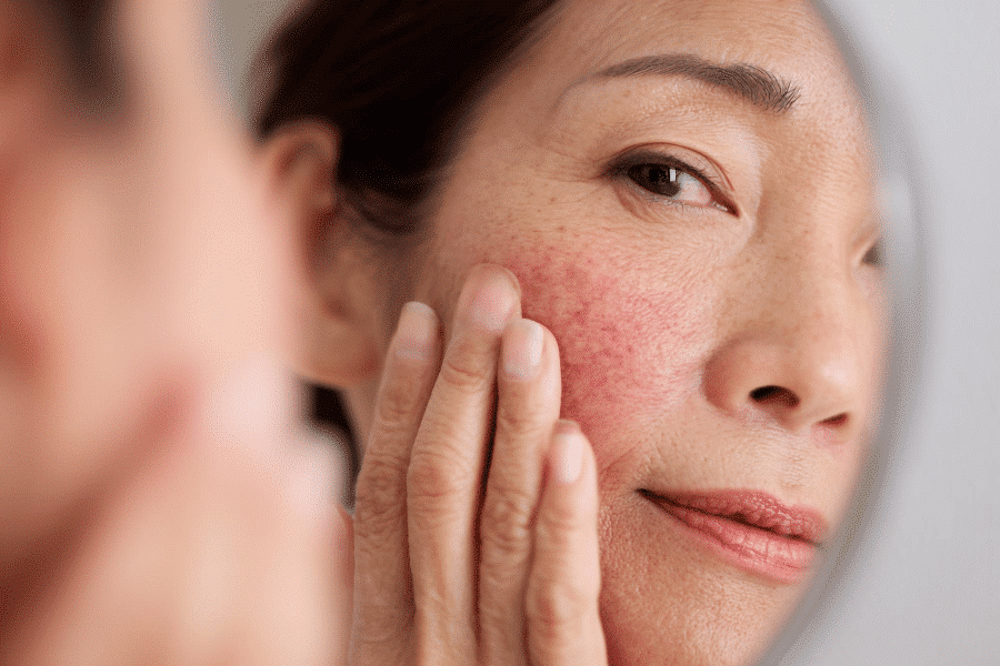 Irritation & Redness