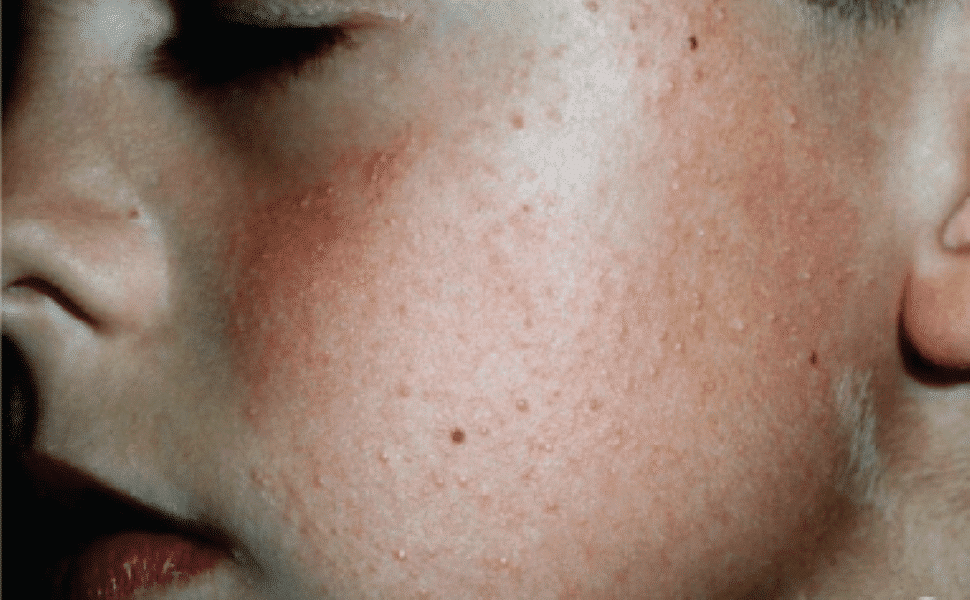 Facial KP