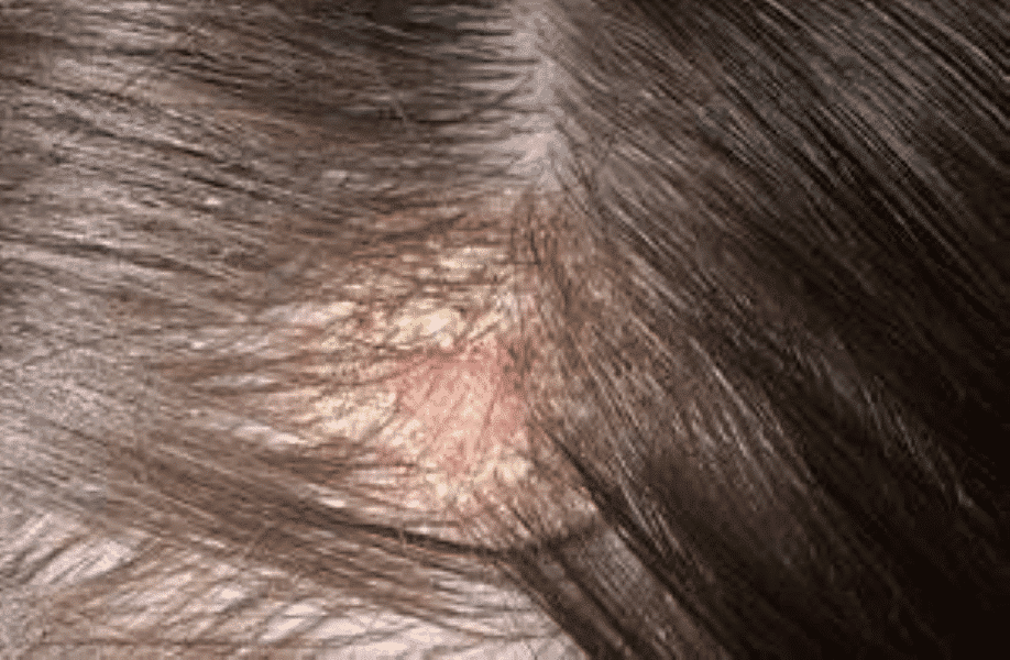 Malassezia Overgrowth