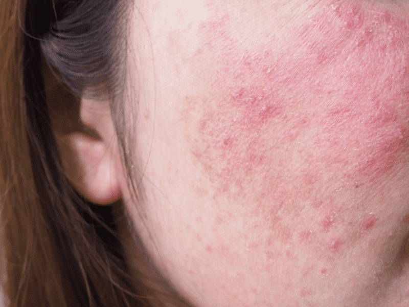 Inflammation and Barrier Stress