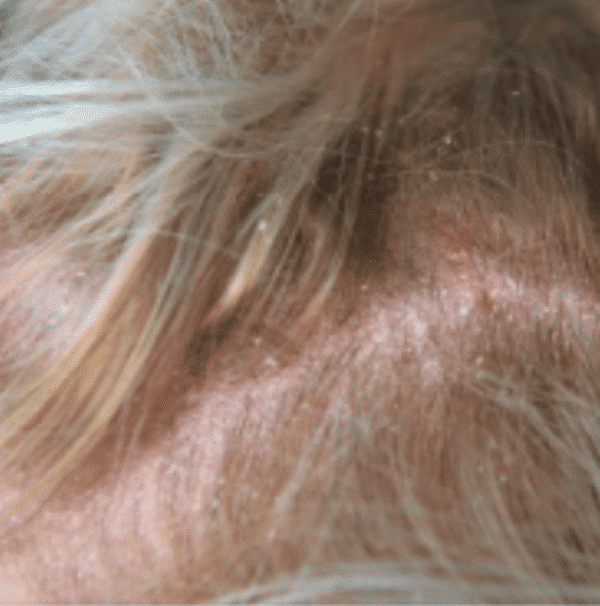 Scalp