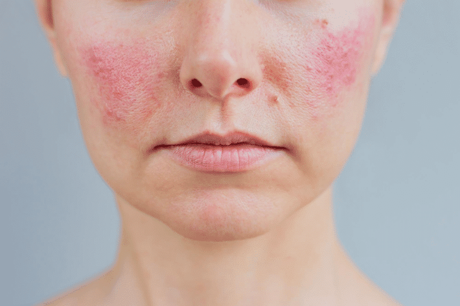 Immune Inflammation