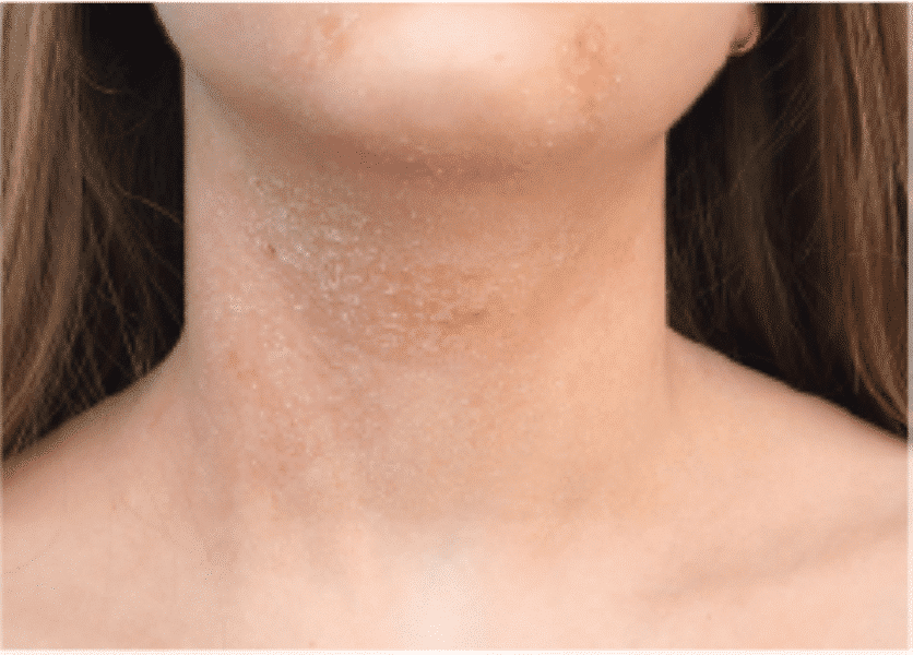 Flexural Areas